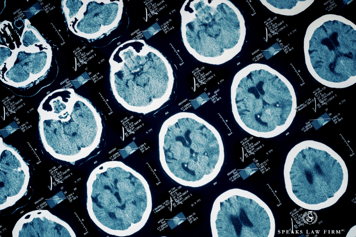What Is a Catastrophic Injury? Experienced Charlotte Catastrophic Injury Lawyers Explain What You Need To Know 3 TBIs range from mild concussions